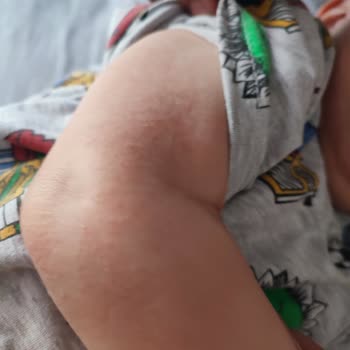 Bebeğim Möller's Balık Yağı Sonrası Alerjik Reaksiyon Geçirdi Ve Fiyat Farkı Yaşadım