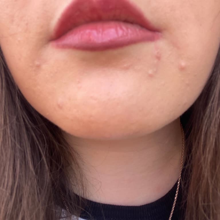 Vinopure de Caudalie me causó más acné tras usar dos cajas