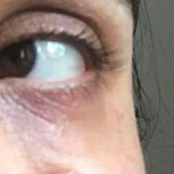 Reacción alérgica tras usar crema Caudalie contorno de ojos