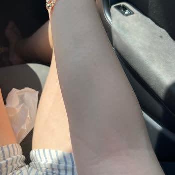 Bronzlaştırıcı Yağ Cildimde Alerjik Reaksiyona Sebep Oldu