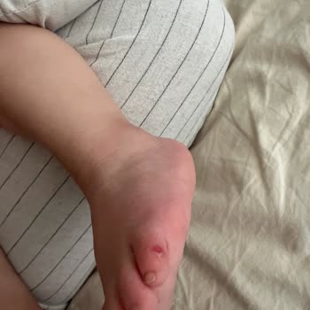 Aldığım İgor Sandalet Bebeğimin Ayağını Yaraladı, Mağduriyetimin Giderilmesini İstiyorum