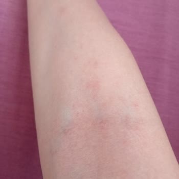 Güneş Kremi Cildimde Sivilce Ve Kaşıntı Yaptı!