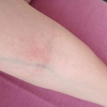 Güneş Kremi Cildimde Sivilce Ve Kaşıntı Yaptı!