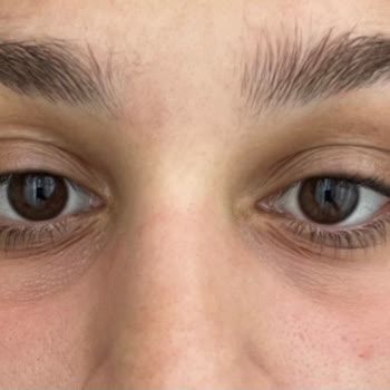 Göz Serumunda Yanma Ve Kızarıklık Sonrası Hayal Kırıklığı