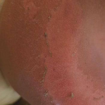 Bronzing Bomb Losyon Tatilimi Mahvetti Kalıcı Bronzluk Beklerken Hayal Kırıklığı