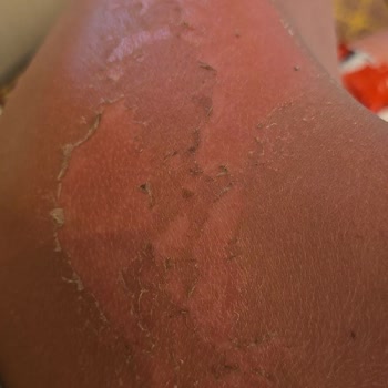 Bronzing Bomb Losyon Tatilimi Mahvetti Kalıcı Bronzluk Beklerken Hayal Kırıklığı