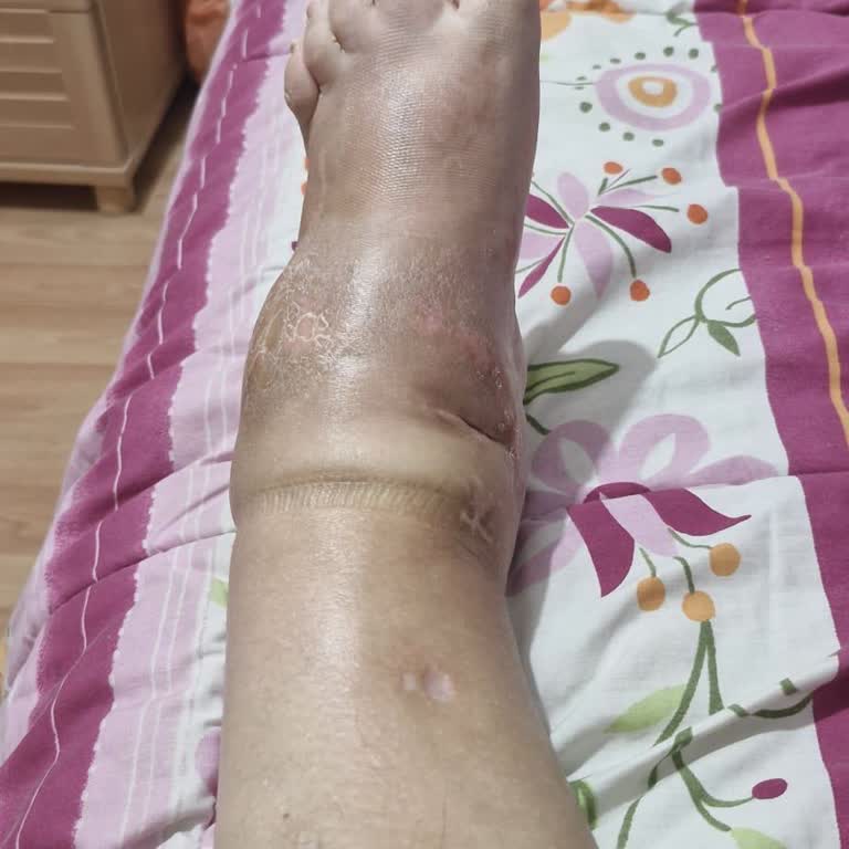 Ameliyat Sonrası Yanıltıcı Bilgilendirme Ve Olumsuz Sonuç