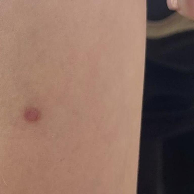 Jahzara Vip Güzellik Merkezi Küçük Ben Aldırma İşlemi Sonrası İz ve Yara Problemi