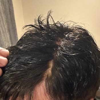 Protez Saçta Sürekli Dökülme Ve İlgisiz Hizmet