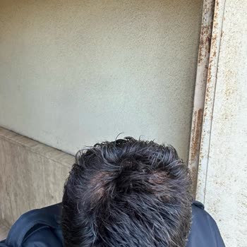 Protez Saçta Sürekli Dökülme Ve İlgisiz Hizmet