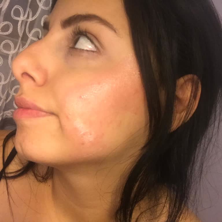 Abdi İbrahim Sarı Hametan Krem Yüzümde Kızarıklık Ve Yanık İzi Yaptı