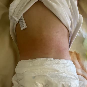 Sleepy Bebek Bezi Alerji Yaptı, Oğlumda Cilt Sorunları Oluştu