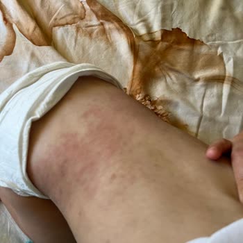 Sleepy Bebek Bezi Alerji Yaptı, Oğlumda Cilt Sorunları Oluştu