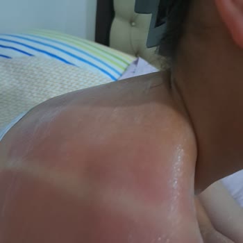 Nivea 50 Faktör Çocuk Güneş Kremi Güneş Yanıklarını Önlemedi