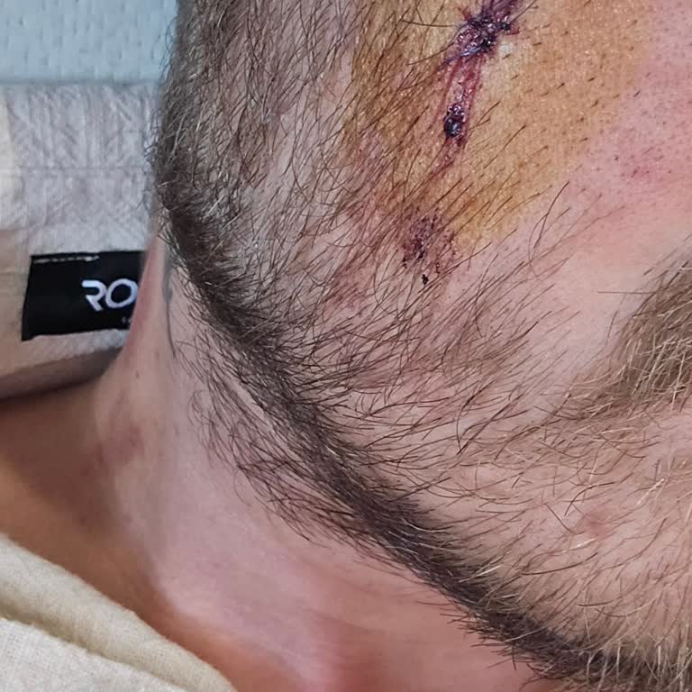 Fahiş Fiyat Ve Kötü Hizmet: 6 Yamuk Dikişe 9 Bin TL!