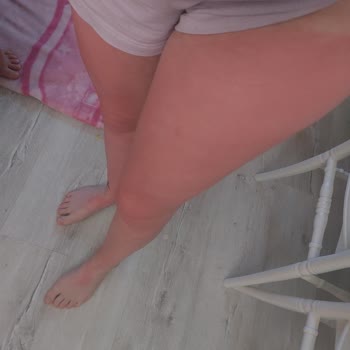 Aldığım Güneş Kremi Cildimizi Korumak Yerine Yaktı