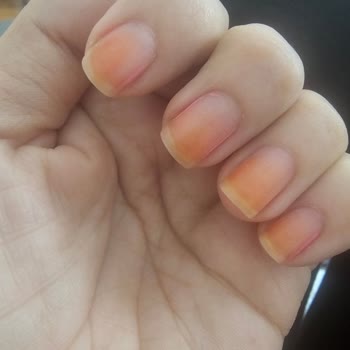 Oje Sonrası Tırnaklarımda Kalıcı Hasar Oluştu