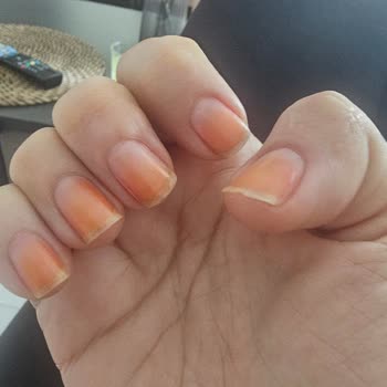 Oje Sonrası Tırnaklarımda Kalıcı Hasar Oluştu