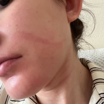 Aldığım Güneş Kremi Cildimde Yanma Yaptı