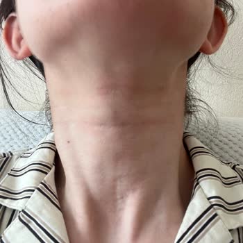 Aldığım Güneş Kremi Cildimde Yanma Yaptı