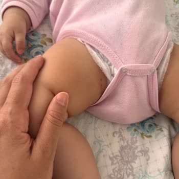 Molfix Bebek Bezinde Bacaklarda İz Ve Yara Oluşumu