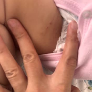 Molfix Bebek Bezinde Bacaklarda İz Ve Yara Oluşumu