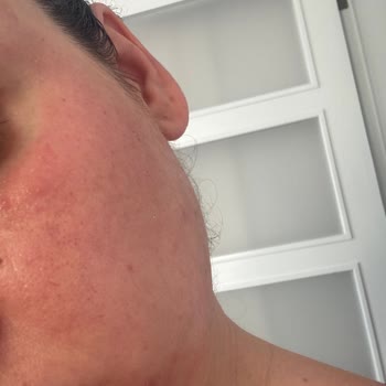 Nivea Yüz Temizleme Jelinden Sonra Cilt Sorunu Yaşadım