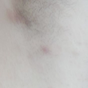 Rexona Quantum Dry Sonrası Sağlık Sorunu Ve Güvensizlik