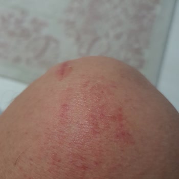 Kulaksız Mezarlığında Köpek Saldırısı Ve Önlem Eksikliği