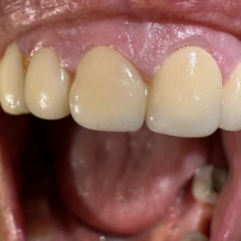 İntermed Çiftehavuzlar Polikliniği Eksik Ve Hatalı Zirkonyum Kuron Tedavisi Nedeniyle Mağduriyet