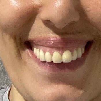 İntermed Çiftehavuzlar Polikliniği Eksik Ve Hatalı Zirkonyum Kuron Tedavisi Nedeniyle Mağduriyet