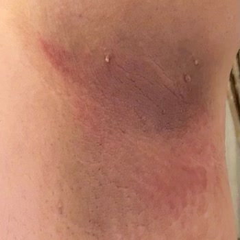 Veet Tüy Dökücü Krem Cildimde Yanık Ve Tahrişe Sebep Oldu