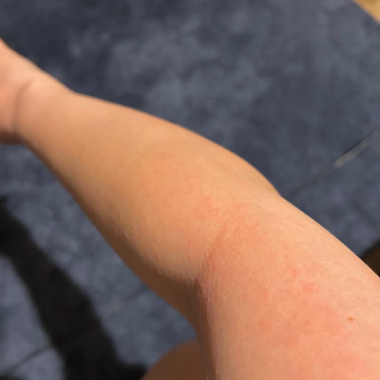 Eda Taşpınar Bronzing Bomb Ciltte Alerjik Reaksiyona Sebep Oldu