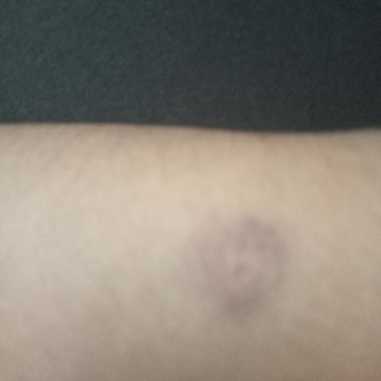 Kızılay'da Kan Verme Sonrası Ani Tansiyon Düşüşü Yaşadım