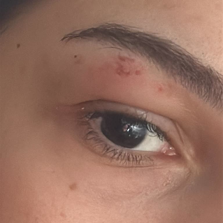 Benefit Kaş Bar'da Kaş Alımı Sonrası Yaralanma Ve Memnuniyetsizlik