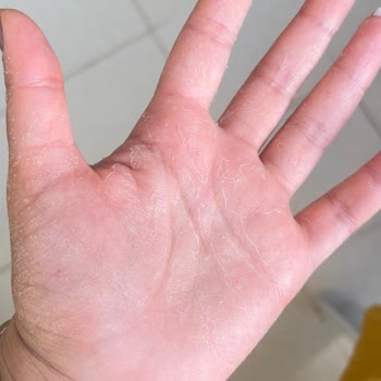 Cif Yağ Sökücü Ellerimde Ciddi Tahrişe Yol Açtı