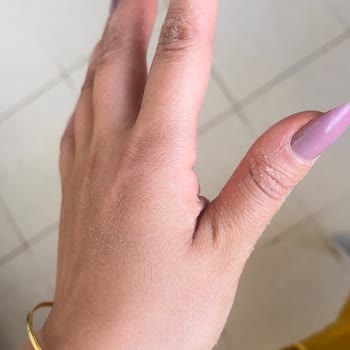 Cif Yağ Sökücü Ellerimde Ciddi Tahrişe Yol Açtı