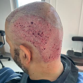 Berkay Tulpar Clinic Saç Ekimi Sonrası Hayal Kırıklığı Ve Klinik İlgisizliği