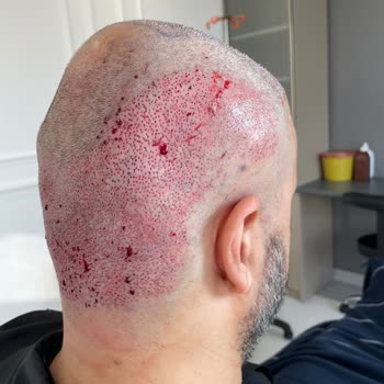 Berkay Tulpar Clinic Saç Ekimi Sonrası Hayal Kırıklığı Ve Klinik İlgisizliği