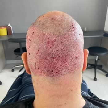 Berkay Tulpar Clinic Saç Ekimi Sonrası Hayal Kırıklığı Ve Klinik İlgisizliği