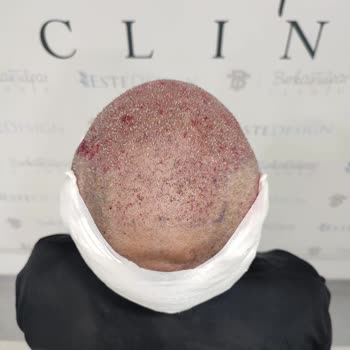 Berkay Tulpar Clinic Saç Ekimi Sonrası Hayal Kırıklığı Ve Klinik İlgisizliği