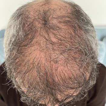 Berkay Tulpar Clinic Saç Ekimi Sonrası Hayal Kırıklığı Ve Klinik İlgisizliği