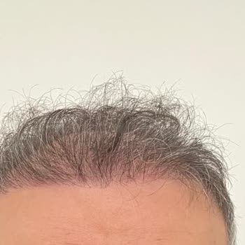 Berkay Tulpar Clinic Saç Ekimi Sonrası Hayal Kırıklığı Ve Klinik İlgisizliği