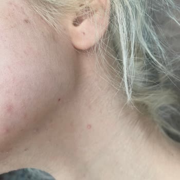 Morfose Çift Fazlı Nem Spreyi Cildimde Sivilce Yaptı