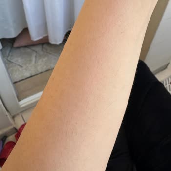 Lazer Epilasyon Sonuçsuz Kaldı, Sorunuma Çözüm Bulunmadı