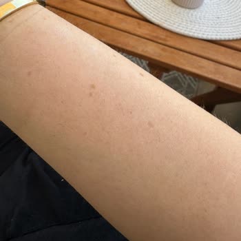 Lazer Epilasyon Sonuçsuz Kaldı, Sorunuma Çözüm Bulunmadı