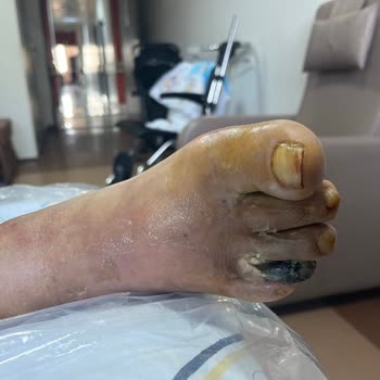 Hastanede İhmalkarlık Yüzünden Ayak Parmakları Kesilme Riskiyle Karşı Karşıya