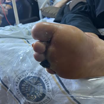 Hastanede İhmalkarlık Yüzünden Ayak Parmakları Kesilme Riskiyle Karşı Karşıya