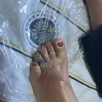 Hastanede İhmalkarlık Yüzünden Ayak Parmakları Kesilme Riskiyle Karşı Karşıya