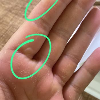 Fairy Bulaşık Deterjanı Ciltte Ciddi Yanıklara Yol Açtı